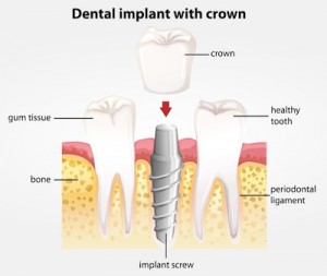 dental implants anoka